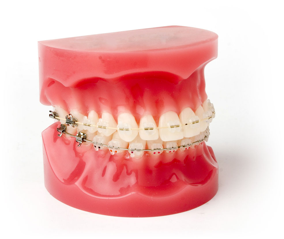 Do You Know The Parts Of Your Braces? (And Why It's Important)