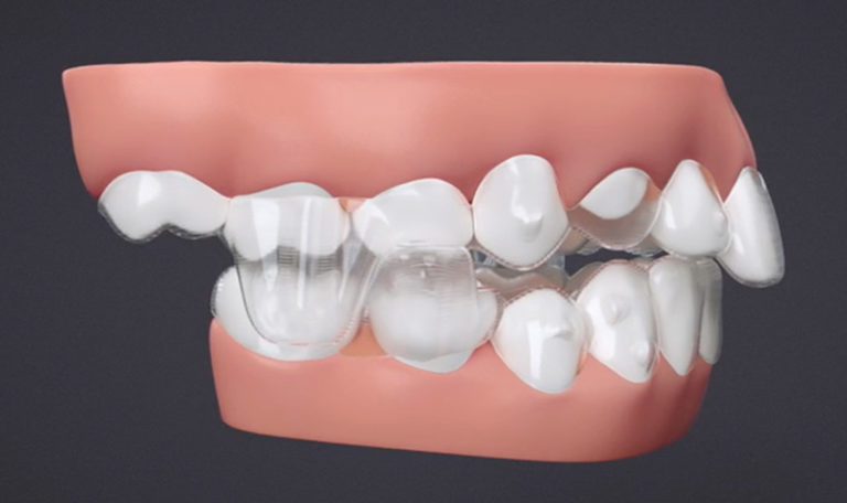 Invisalign With Mandibular Advancement Innovative Orthodontic Centers 