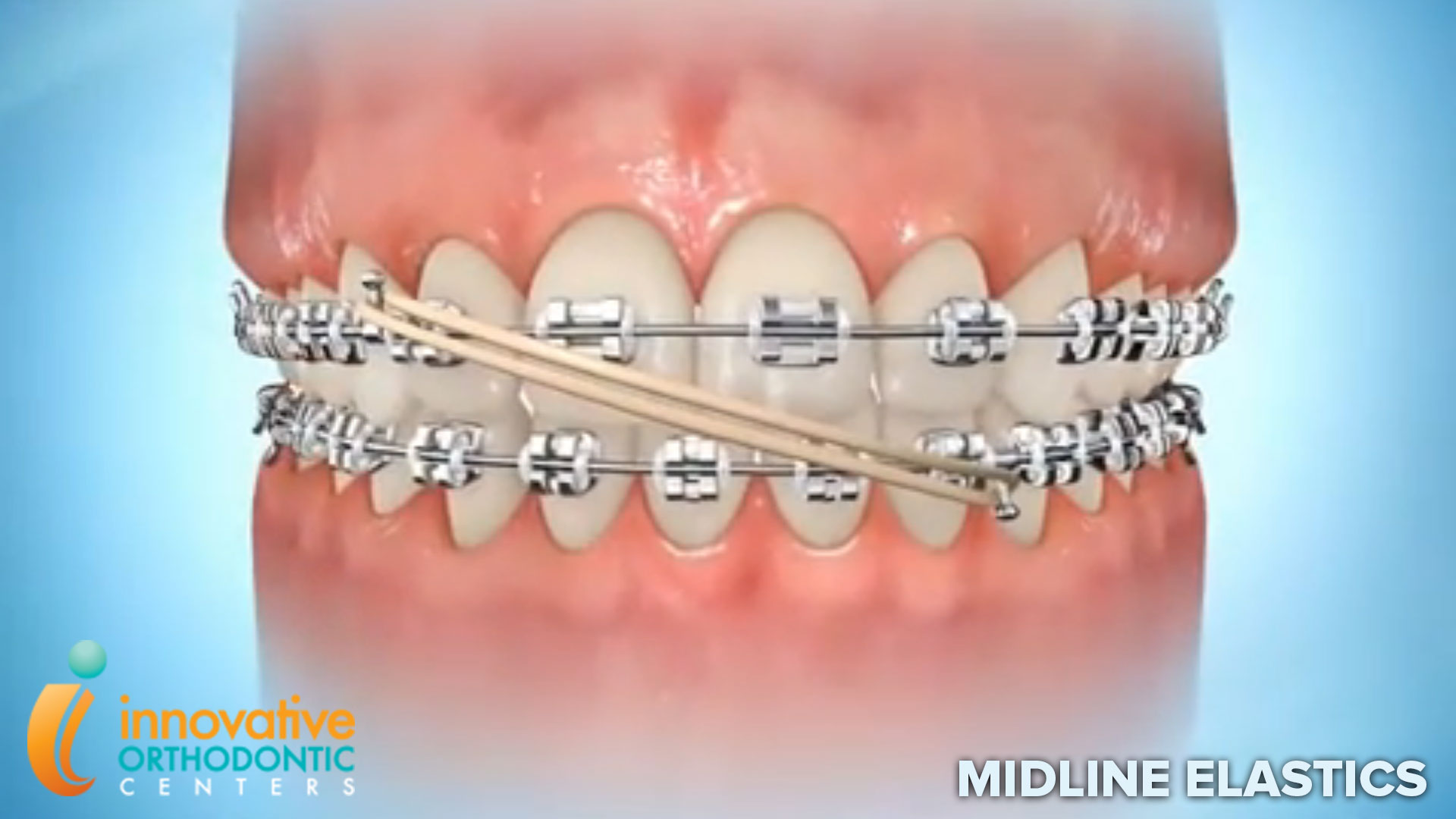 Parts of Braces  Innovative Orthodontic Centers