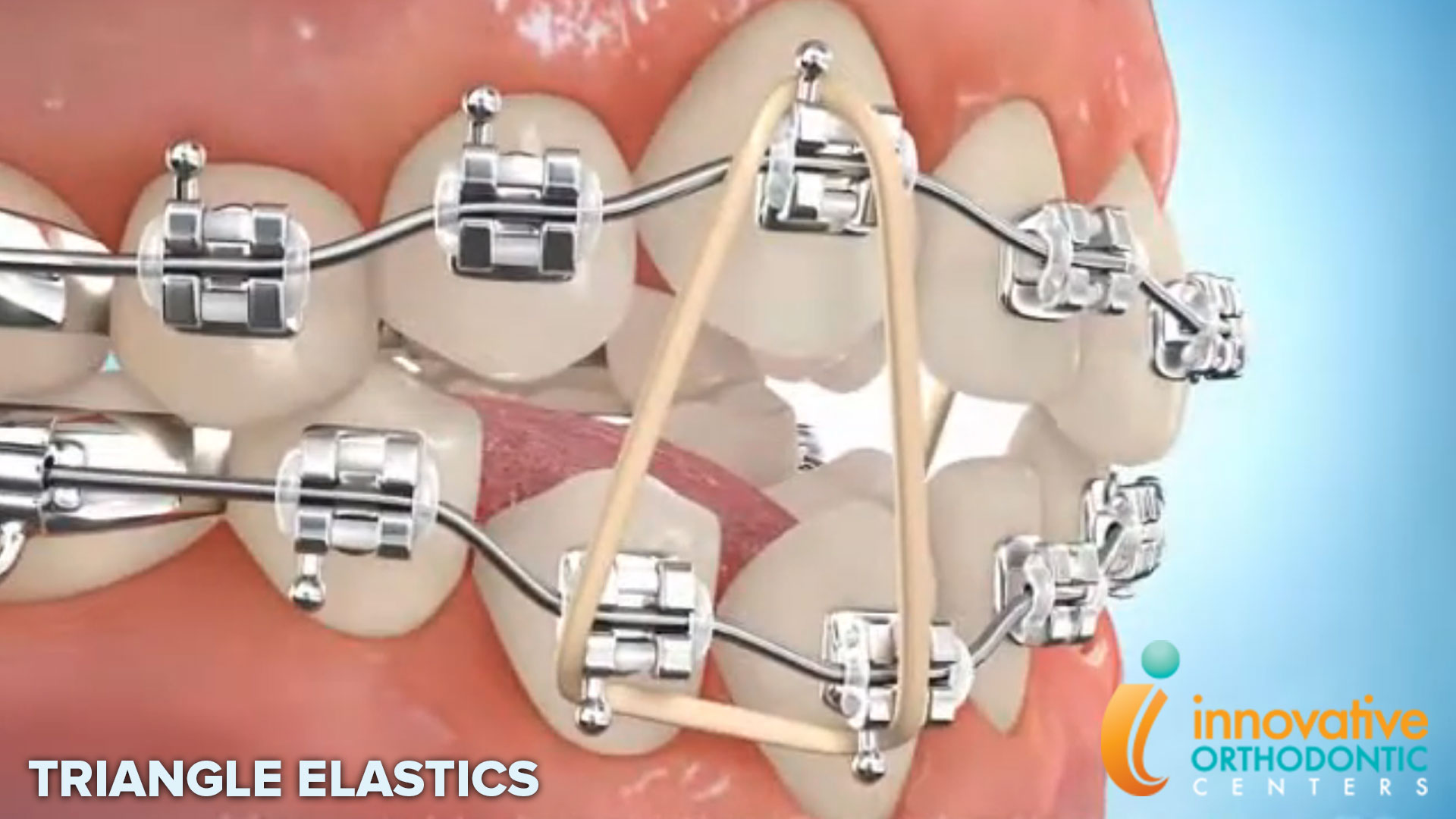 Parts of Braces  Innovative Orthodontic Centers