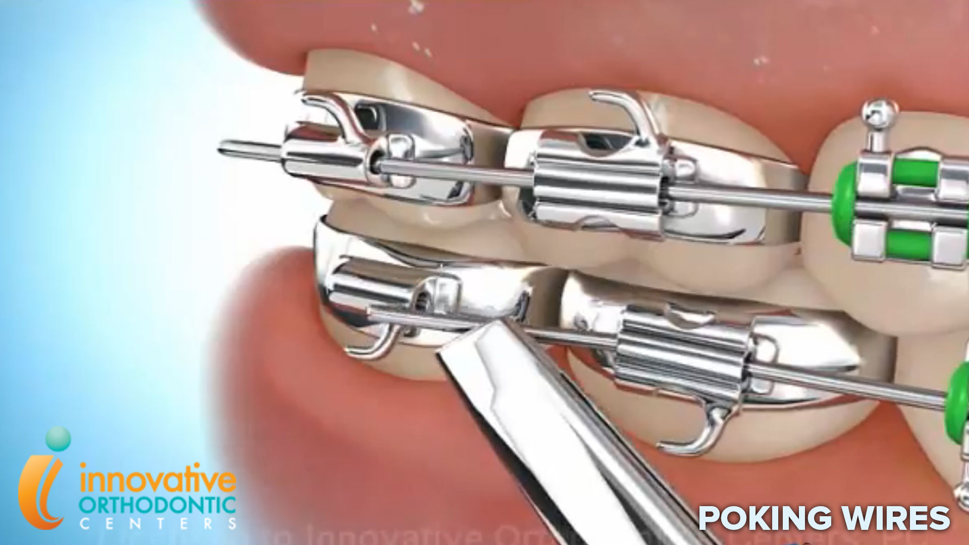 How to Ease the Pain of Poking Wires on Braces